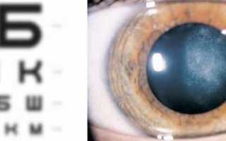 Эффективное лечение начальной катаракты