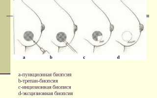 Особенности проведения инцизионной и эксцизионной биопсии