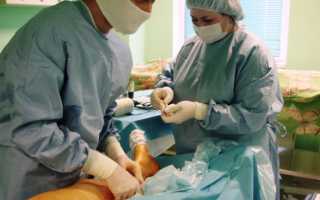 Флебэктомия — операция по удалению варикозных вен на ногах