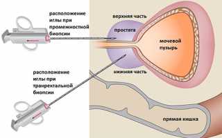 Как проводится биопсия простаты?