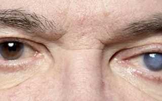 4 опасных осложнения глаукомы