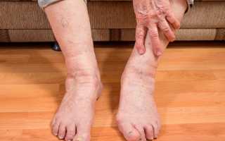 Отек ног у пожилых людей: причины, лечение, возможные риски