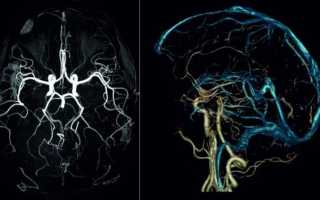 Методика ангиографии сосудов мозга и головы