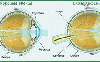 Полезные упражнения для глаз при миопическом астигматизме
