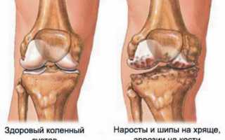 Изменения и патологии на рентгене коленного сустава