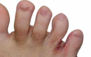 Эффективное лечение грибка между пальцев ног