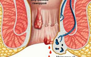 Наружный геморрой: симптомы и лечение