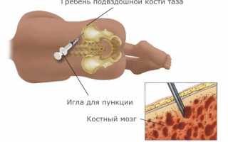 Описание процедуры биопсии костного мозга