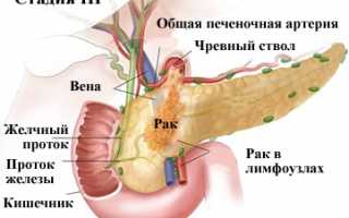 Симптомы и проявления рака поджелудочной железы