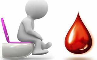 Кровь при дефекации: определение причины по цвету кровяных выделений