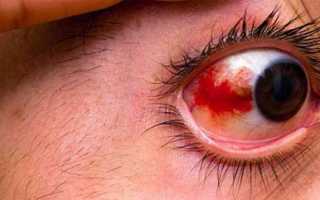 Как действовать при повреждении роговицы глаза