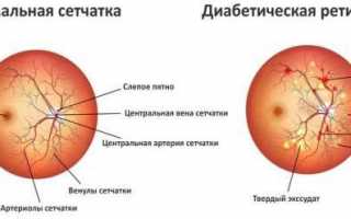 3 стадии диабетической ретинопатии