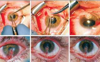Язвенные поражения роговицы глаза и возможная потеря зрения