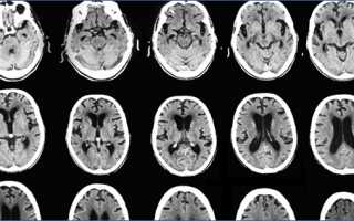 Метод нейровизуализации при помощи КТ головного мозга