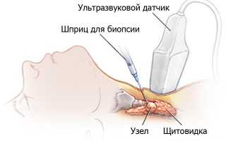 Как выполняется пункционная биопсия?