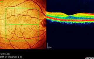 Уникальный метод оптической когерентной томографии