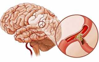 Церебральный атеросклероз – основные опасности и методы лечения