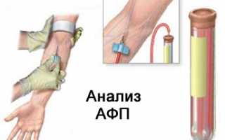 Повышенная концентрация АФП в анализе крови