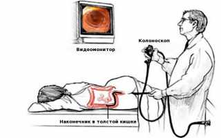 Для чего делают колоноскопию кишечника?