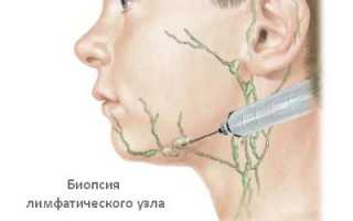 Для чего и как проводится биопсия лимфоузла?