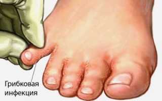 Причины и лечение трещин между пальцами ног