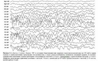 Что показывает ЭЭГ в детском возрасте: критерии диагностики при различных заболеваниях