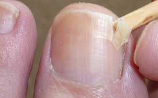 Лечение трещин на ногтях рук