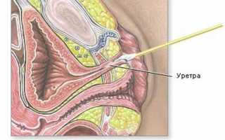 Подготовка и взятие мазка из уретры у женщин
