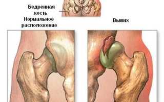 Видимые патологии на рентгене тазобедренного сустава