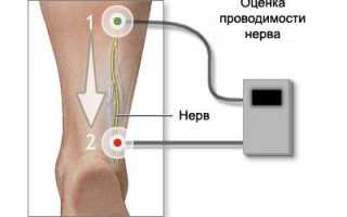 Виды и показания к электромиографии