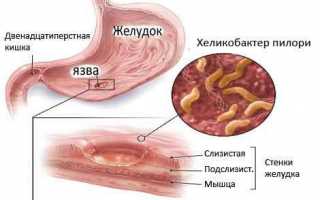 Эндоскопическая биопсия желудка