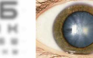 5 лучших средств от незрелой катаракты