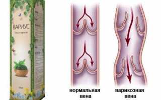 Правда ли помогает гель от варикоза Вариус?