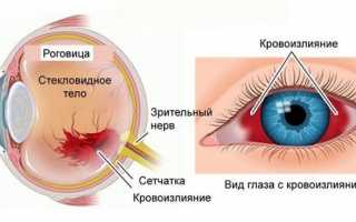 Важность срочного лечения гемофтальма или кровоизлияния в глазу