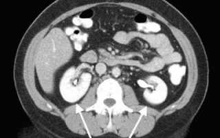 Процедура компьютерной томографии почек