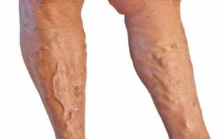 Тромб в ноге: признаки и принципы лечения