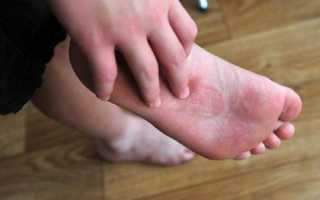 Чем лечить грибок на ногах ребенка