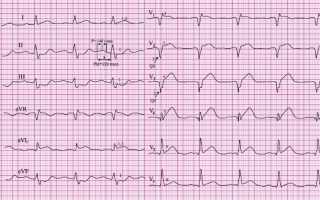 Расшифровка ЭКГ при инфаркте миокарда