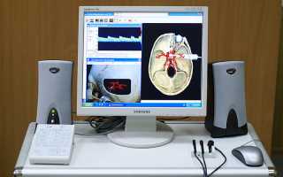Высокоинформативный метод транскраниальной допплерография сосудов головного мозга