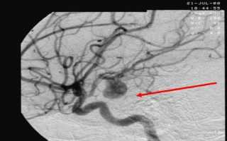 Что такое селективное церебральное исследование методом ангиографии сосудов
