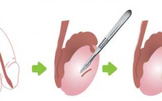 Описание процедуры биопсии яичка