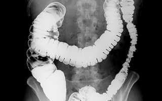 Методы проверки кишечника на онкологию без колоноскопии